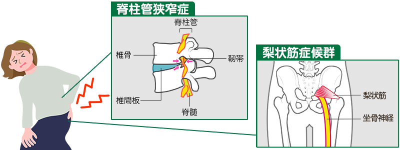 脊柱管狭窄症や梨状筋症候群のイメージ